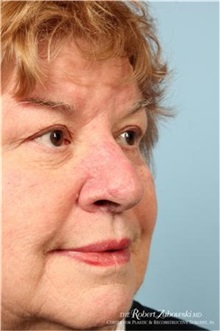 Head and Neck Skin Cancer Reconstruction After Photo by Robert Zubowski, MD; Paramus, NJ - Case 34548