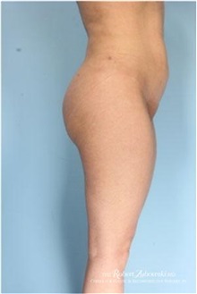 Buttock Implants After Photo by Robert Zubowski, MD; Paramus, NJ - Case 34552
