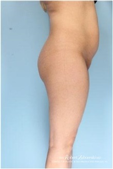Buttock Implants Before Photo by Robert Zubowski, MD; Paramus, NJ - Case 34552
