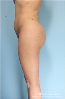 Buttock Implants After Photo by Robert Zubowski, MD; Paramus, NJ - Case 34553
