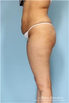 Buttock Implants Before Photo by Robert Zubowski, MD; Paramus, NJ - Case 34554