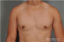 Male Breast Reduction After Photo by Robert Zubowski, MD; Paramus, NJ - Case 34556