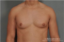 Male Breast Reduction Before Photo by Robert Zubowski, MD; Paramus, NJ - Case 34556