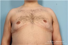 Male Breast Reduction After Photo by Robert Zubowski, MD; Paramus, NJ - Case 34558