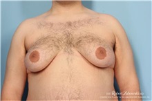 Male Breast Reduction Before Photo by Robert Zubowski, MD; Paramus, NJ - Case 34558