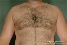 Male Breast Reduction After Photo by Robert Zubowski, MD; Paramus, NJ - Case 34559