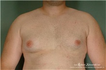 Male Breast Reduction Before Photo by Robert Zubowski, MD; Paramus, NJ - Case 34559