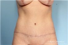 Tummy Tuck After Photo by Robert Zubowski, MD; Paramus, NJ - Case 34560