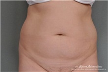Tummy Tuck Before Photo by Robert Zubowski, MD; Paramus, NJ - Case 34560