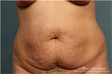 Tummy Tuck Before Photo by Robert Zubowski, MD; Paramus, NJ - Case 34561
