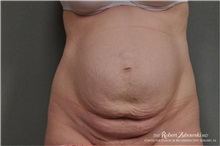 Tummy Tuck Before Photo by Robert Zubowski, MD; Paramus, NJ - Case 34562