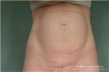 Tummy Tuck Before Photo by Robert Zubowski, MD; Paramus, NJ - Case 34563