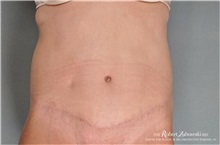 Tummy Tuck After Photo by Robert Zubowski, MD; Paramus, NJ - Case 34565