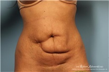 Tummy Tuck Before Photo by Robert Zubowski, MD; Paramus, NJ - Case 34566