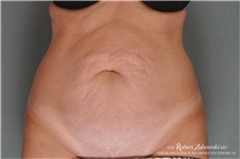 Tummy Tuck Before Photo by Robert Zubowski, MD; Paramus, NJ - Case 34568