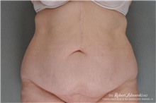 Tummy Tuck Before Photo by Robert Zubowski, MD; Paramus, NJ - Case 34569