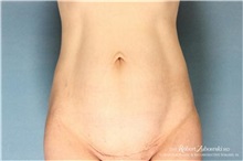 Tummy Tuck Before Photo by Robert Zubowski, MD; Paramus, NJ - Case 34570