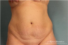Tummy Tuck Before Photo by Robert Zubowski, MD; Paramus, NJ - Case 34571