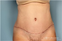 Tummy Tuck After Photo by Robert Zubowski, MD; Paramus, NJ - Case 34576