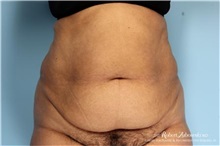 Tummy Tuck Before Photo by Robert Zubowski, MD; Paramus, NJ - Case 34578