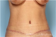 Tummy Tuck After Photo by Robert Zubowski, MD; Paramus, NJ - Case 34580