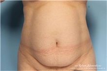 Tummy Tuck Before Photo by Robert Zubowski, MD; Paramus, NJ - Case 34580