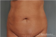 Tummy Tuck Before Photo by Robert Zubowski, MD; Paramus, NJ - Case 34581