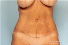 Tummy Tuck After Photo by Robert Zubowski, MD; Paramus, NJ - Case 34582