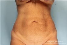 Tummy Tuck Before Photo by Robert Zubowski, MD; Paramus, NJ - Case 34582