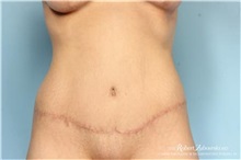Tummy Tuck After Photo by Robert Zubowski, MD; Paramus, NJ - Case 34584