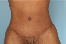 Tummy Tuck After Photo by Robert Zubowski, MD; Paramus, NJ - Case 35236
