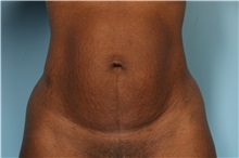 Tummy Tuck Before Photo by Robert Zubowski, MD; Paramus, NJ - Case 35236