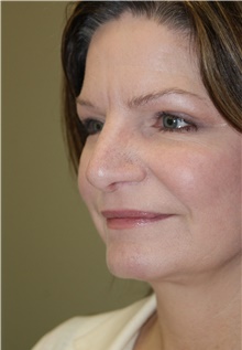 Facelift After Photo by Michael Epstein, MD, FACS; Northbrook, IL - Case 23752