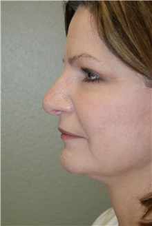 Facelift After Photo by Michael Epstein, MD, FACS; Northbrook, IL - Case 23752
