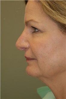 Facelift Before Photo by Michael Epstein, MD, FACS; Northbrook, IL - Case 23752