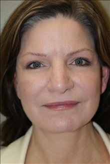 Facelift After Photo by Michael Epstein, MD, FACS; Northbrook, IL - Case 23752