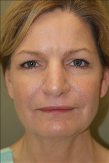 Facelift Before Photo by Michael Epstein, MD, FACS; Northbrook, IL - Case 23752