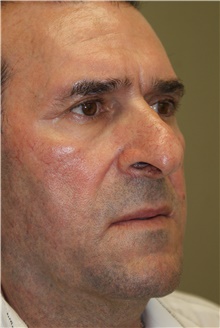 Facelift After Photo by Michael Epstein, MD, FACS; Northbrook, IL - Case 23754