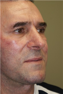 Facelift Before Photo by Michael Epstein, MD, FACS; Northbrook, IL - Case 23754