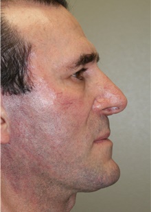 Facelift After Photo by Michael Epstein, MD, FACS; Northbrook, IL - Case 23754