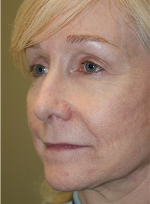 Facelift After Photo by Michael Epstein, MD, FACS; Northbrook, IL - Case 23756