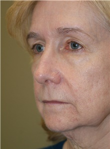 Facelift Before Photo by Michael Epstein, MD, FACS; Northbrook, IL - Case 23756