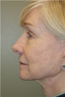 Facelift After Photo by Michael Epstein, MD, FACS; Northbrook, IL - Case 23756