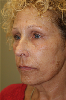 Rhinoplasty Before Photo by Michael Epstein, MD, FACS; Northbrook, IL - Case 23765