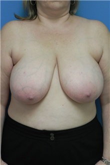 Breast Reduction Before Photo by Michael Epstein, MD, FACS; Northbrook, IL - Case 27559