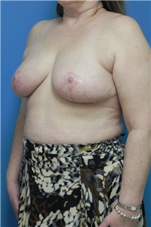 Breast Reduction After Photo by Michael Epstein, MD, FACS; Northbrook, IL - Case 27559