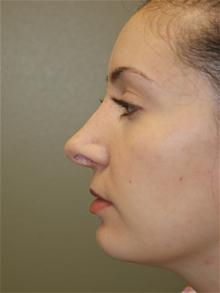 Rhinoplasty After Photo by Michael Epstein, MD, FACS; Northbrook, IL - Case 27717