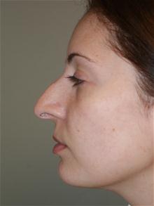 Rhinoplasty Before Photo by Michael Epstein, MD, FACS; Northbrook, IL - Case 27717