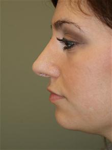 Rhinoplasty After Photo by Michael Epstein, MD, FACS; Northbrook, IL - Case 27718