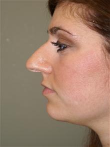 Rhinoplasty Before Photo by Michael Epstein, MD, FACS; Northbrook, IL - Case 27718